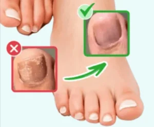 Orivelle-Fungus-Pen-Benefits